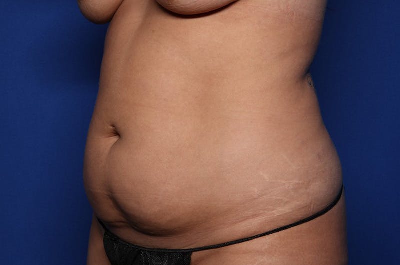 Tummy Tuck Before & After Gallery - Patient 195506 - Image 3