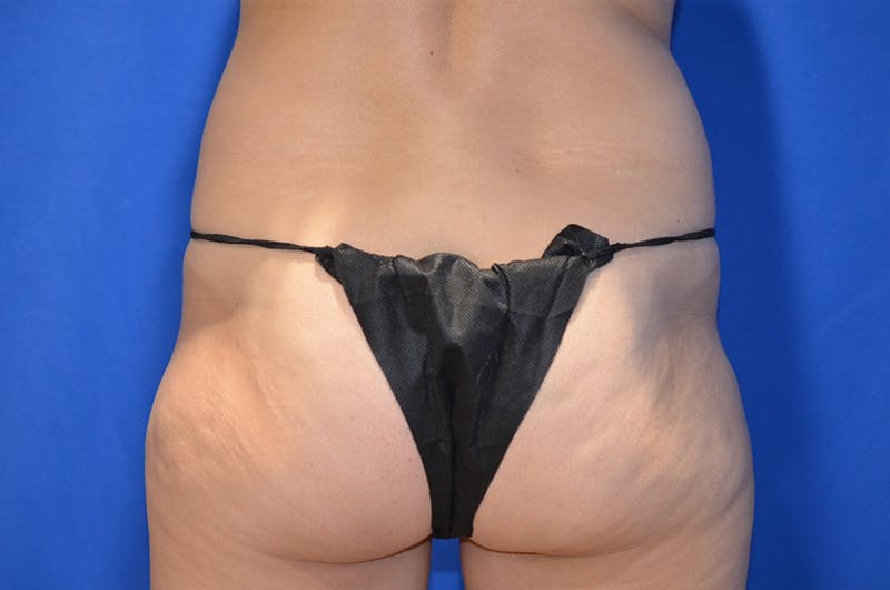 Liposuction Fat Transfer Before & After Gallery - Patient 363478 - Image 5