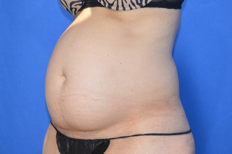 Tummy Tuck Before & After Gallery - Patient 674073 - Image 3