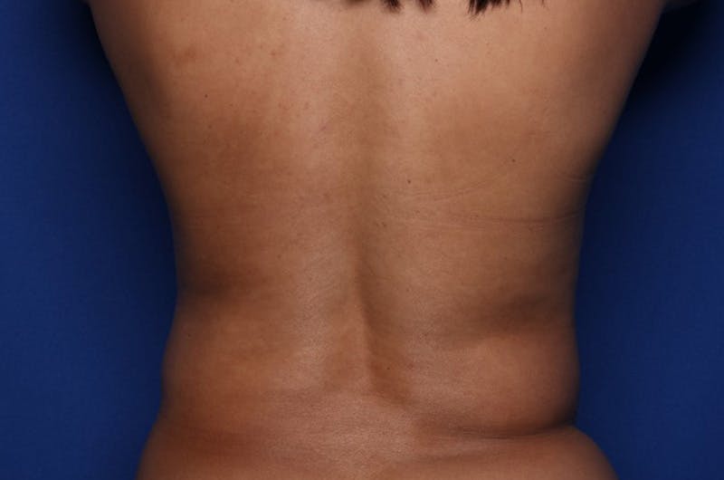 Liposuction Before & After Gallery - Patient 415365 - Image 5