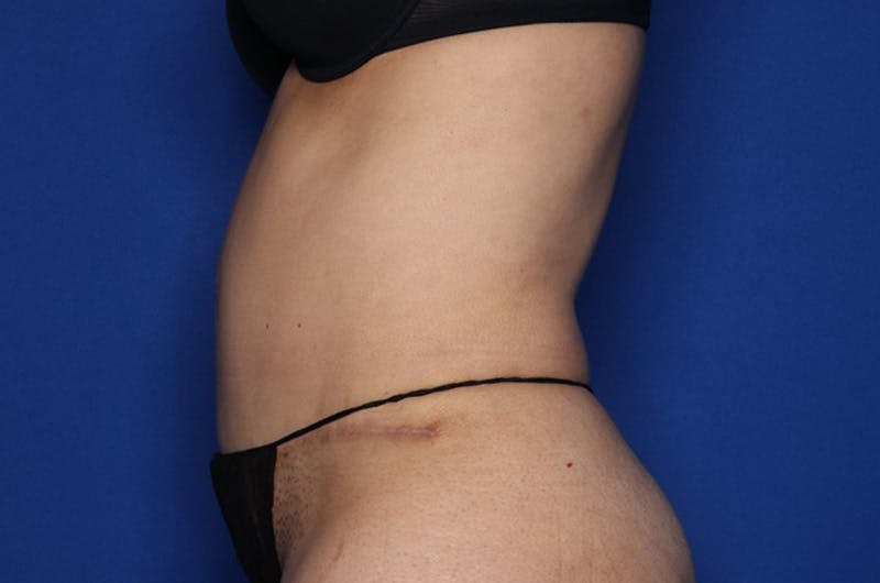 Tummy Tuck Before & After Gallery - Patient 674073 - Image 6