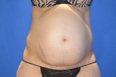 Tummy Tuck Before & After Gallery - Patient 674073 - Image 1