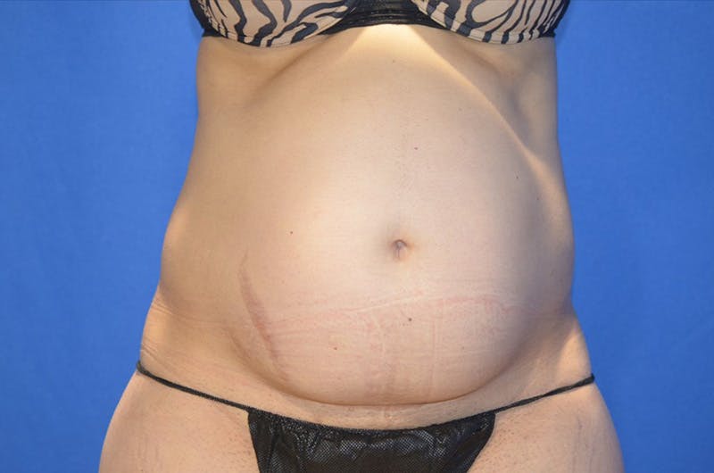 Tummy Tuck Before & After Gallery - Patient 674073 - Image 1