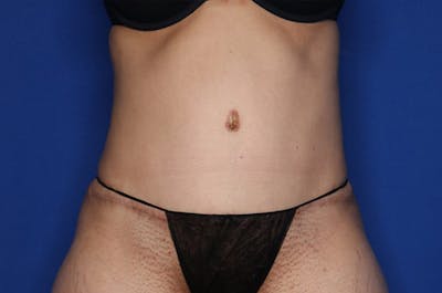 Tummy Tuck Before & After Gallery - Patient 674073 - Image 2