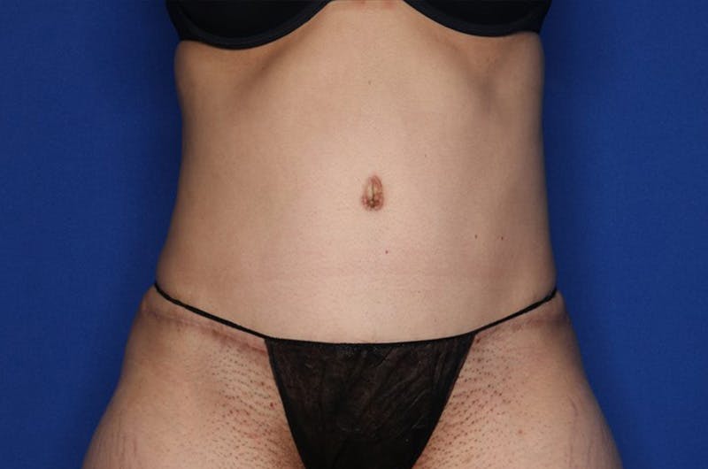 Tummy Tuck Before & After Gallery - Patient 674073 - Image 2