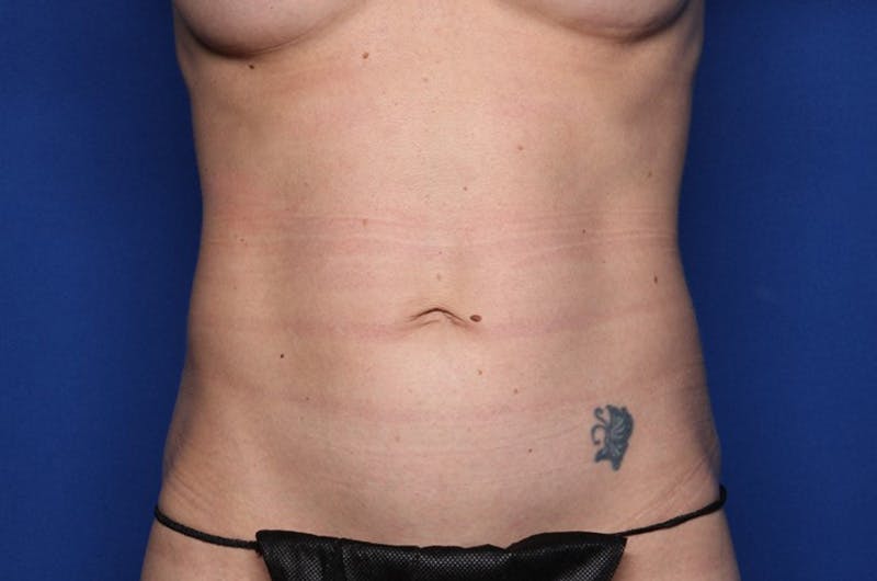 Tummy Tuck Before & After Gallery - Patient 647057 - Image 1
