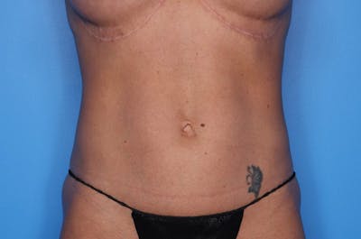 Tummy Tuck Before & After Gallery - Patient 647057 - Image 2