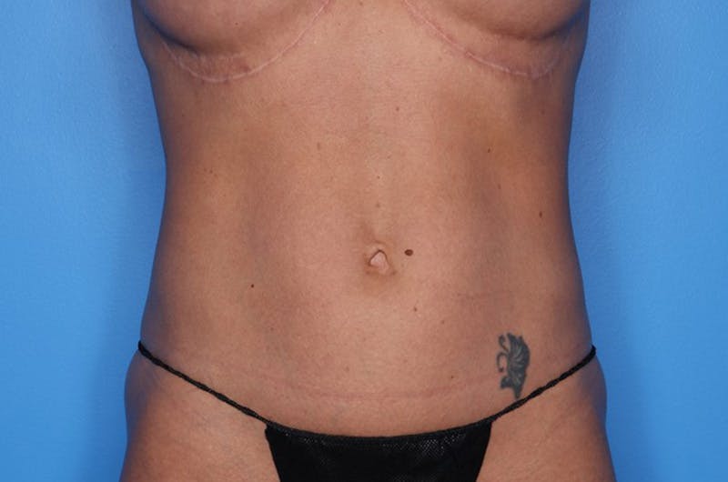 Tummy Tuck Before & After Gallery - Patient 647057 - Image 2