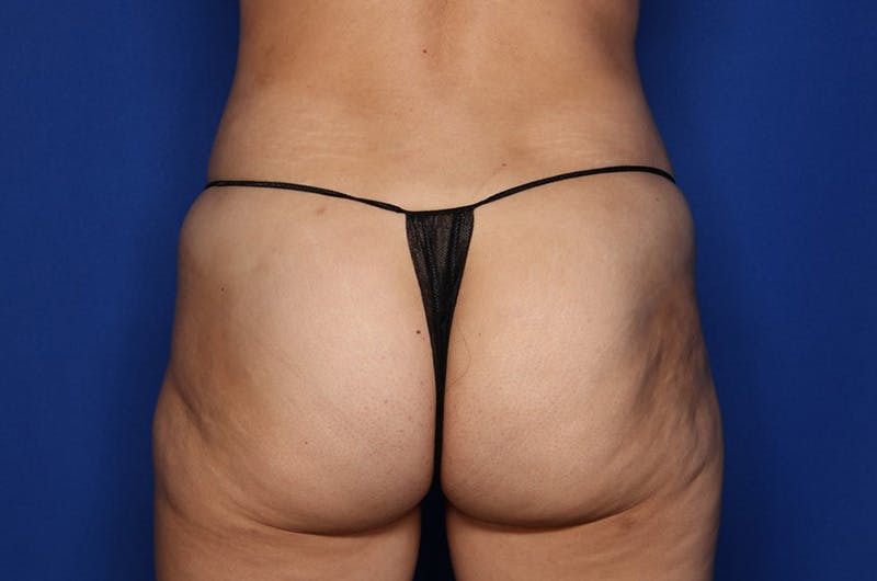 Liposuction Fat Transfer Before & After Gallery - Patient 363478 - Image 6