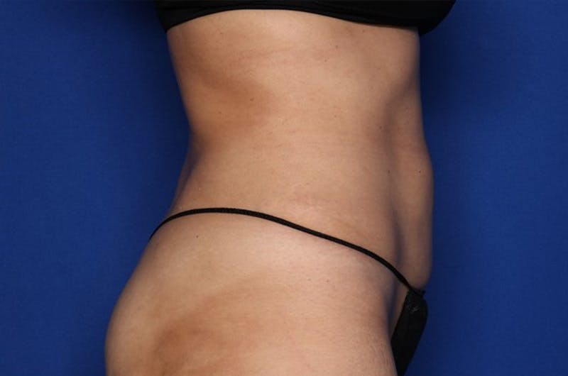 Liposuction Fat Transfer Before & After Gallery - Patient 363478 - Image 4