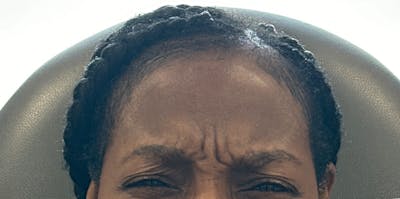 BOTOX Before & After Gallery - Patient 318977 - Image 1