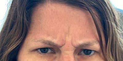 BOTOX Before & After Gallery - Patient 389804 - Image 1