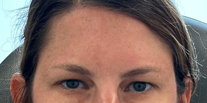 BOTOX Before & After Gallery - Patient 389804 - Image 2