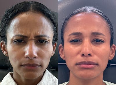 Chin Filler Before & After Gallery - Patient 288115 - Image 1