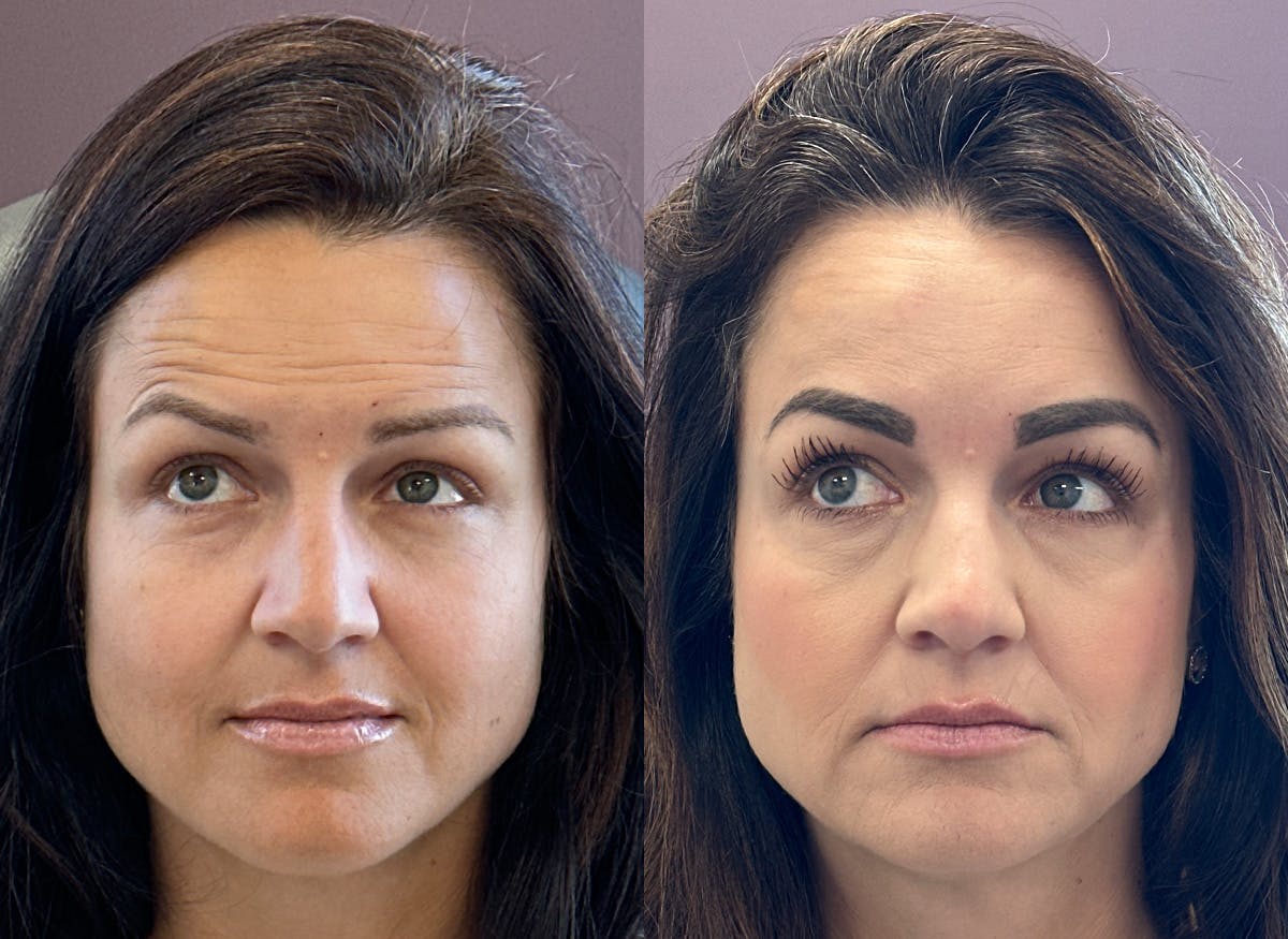 BOTOX Before & After Gallery - Patient 321246 - Image 1