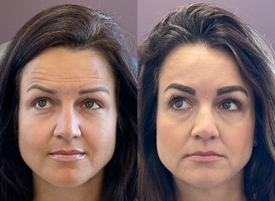 BOTOX Before & After Gallery - Patient 321246 - Image 1