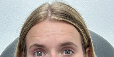 BOTOX Before & After Gallery - Patient 230822 - Image 1