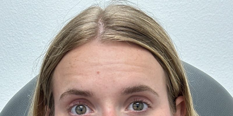 BOTOX Before & After Gallery - Patient 230822 - Image 1