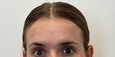 BOTOX Before & After Gallery - Patient 230822 - Image 2