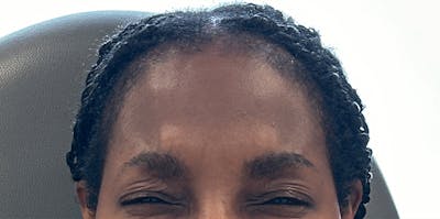 BOTOX Before & After Gallery - Patient 318977 - Image 2