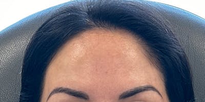 BOTOX Before & After Gallery - Patient 592712 - Image 2