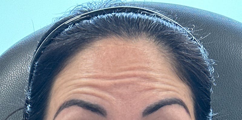BOTOX Before & After Gallery - Patient 592712 - Image 1