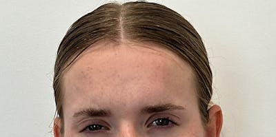 BOTOX Before & After Gallery - Patient 181442 - Image 2