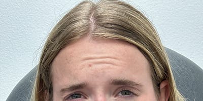 BOTOX Before & After Gallery - Patient 181442 - Image 1