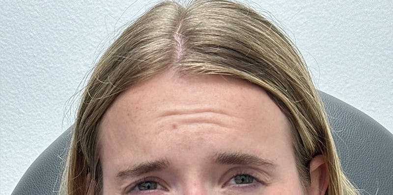 BOTOX Before & After Gallery - Patient 181442 - Image 1
