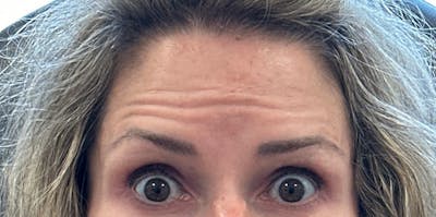 BOTOX Before & After Gallery - Patient 481866 - Image 1