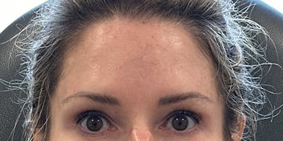 BOTOX Before & After Gallery - Patient 481866 - Image 2