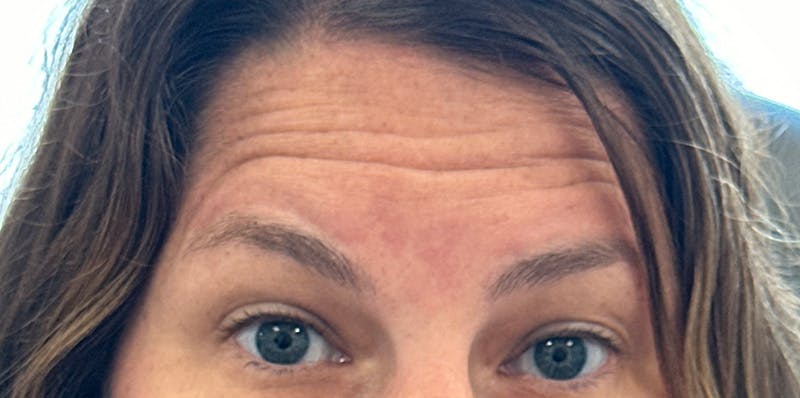 BOTOX Before & After Gallery - Patient 389804 - Image 3