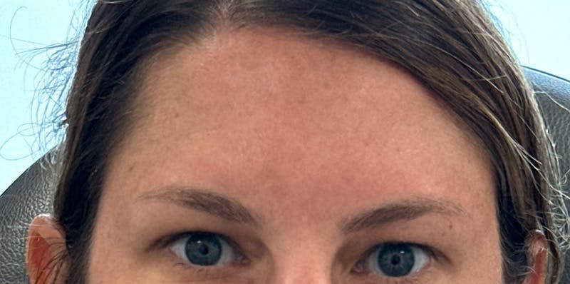 BOTOX Before & After Gallery - Patient 389804 - Image 4