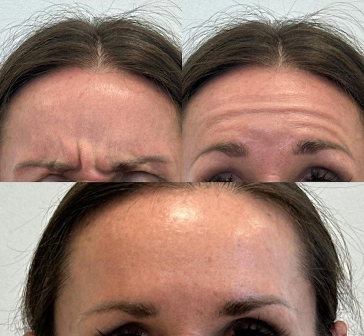 BOTOX Before & After Gallery - Patient 380243 - Image 1