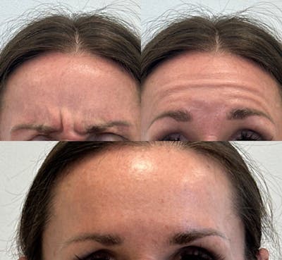 BOTOX Before & After Gallery - Patient 380243 - Image 1