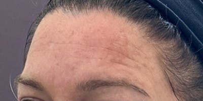 BOTOX Before & After Gallery - Patient 218975 - Image 1