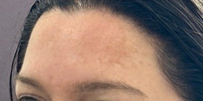 BOTOX Before & After Gallery - Patient 218975 - Image 2