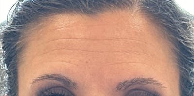 BOTOX Before & After Gallery - Patient 208582 - Image 1