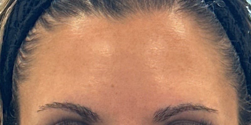 BOTOX Before & After Gallery - Patient 208582 - Image 2