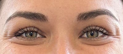 BOTOX Before & After Gallery - Patient 280777 - Image 1