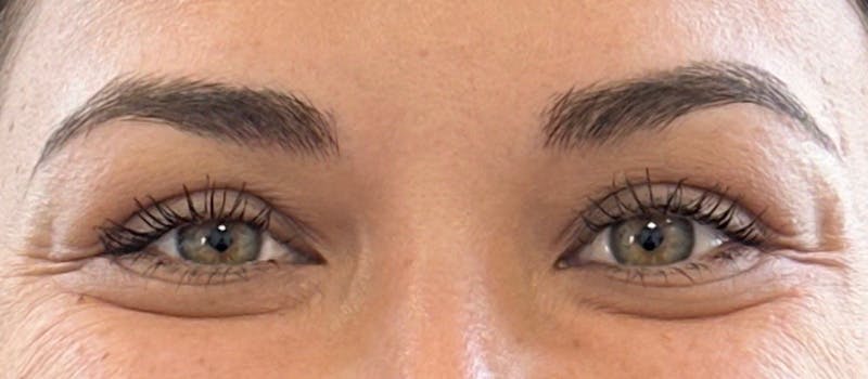 Juvéderm® Before & After Gallery - Patient 668413 - Image 2