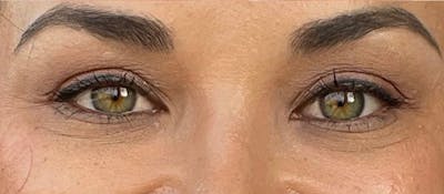 Juvéderm® Before & After Gallery - Patient 668413 - Image 1