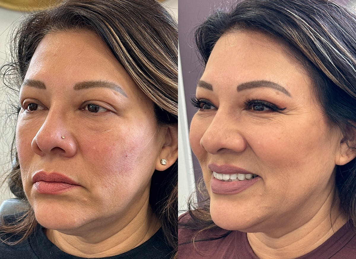 Morpheus8® Before & After Gallery - Patient 268744 - Image 1