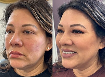 Morpheus8® Before & After Gallery - Patient 268744 - Image 1