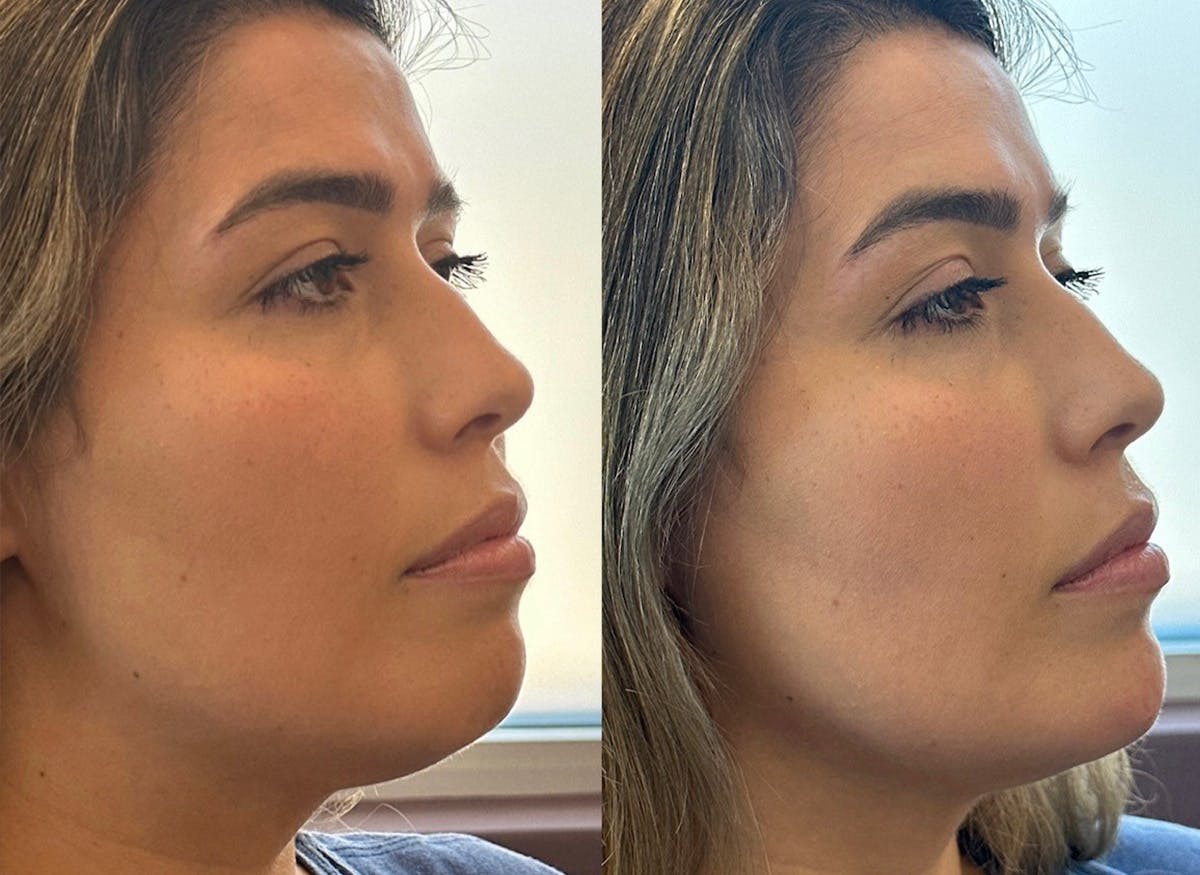 Jawline Filler Before & After Gallery - Patient 273767 - Image 1