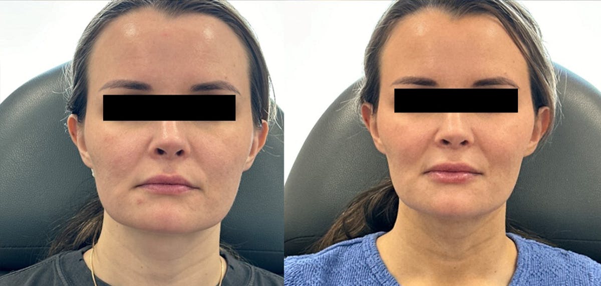 Lip Filler Before & After Gallery - Patient 282826 - Image 1