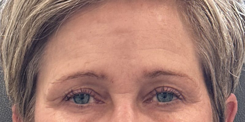 BOTOX Before & After Gallery - Patient 139117 - Image 2