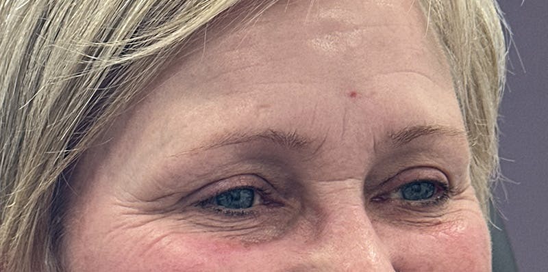 BOTOX Before & After Gallery - Patient 139117 - Image 3