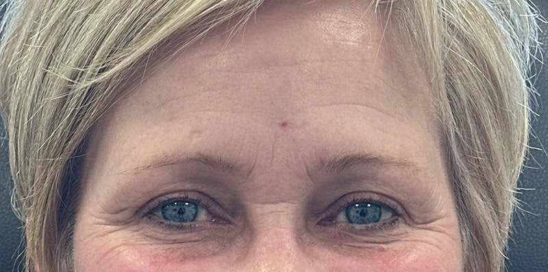 BOTOX Before & After Gallery - Patient 139117 - Image 1