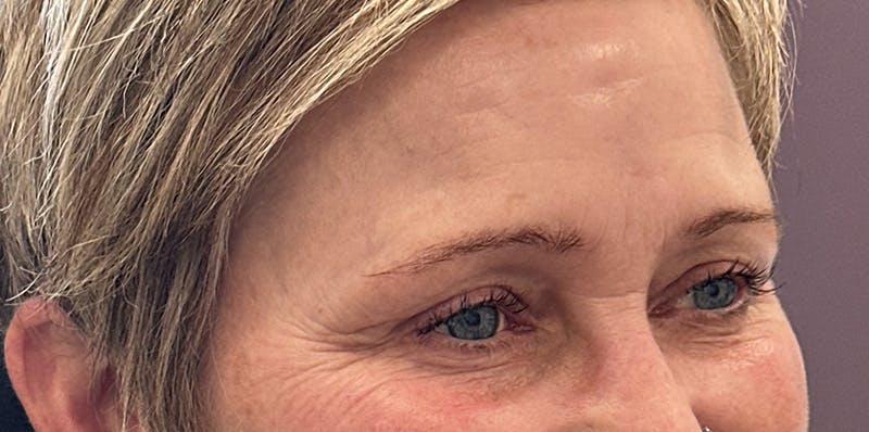 BOTOX Before & After Gallery - Patient 139117 - Image 4